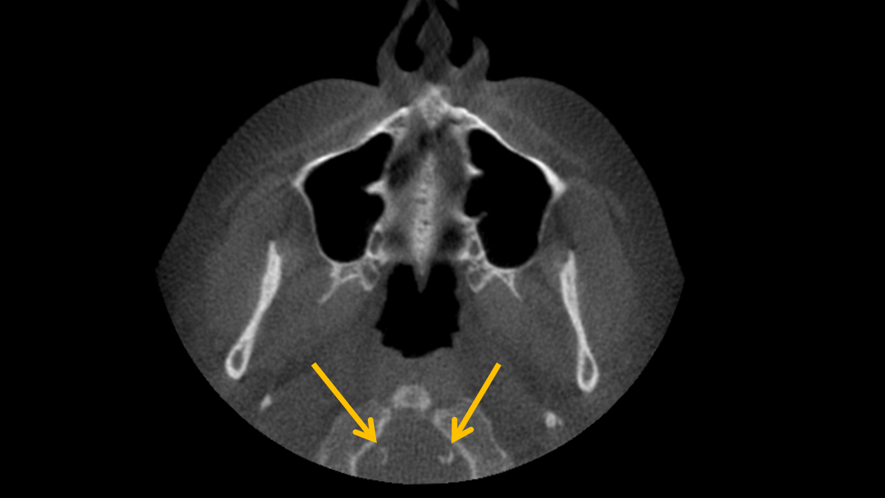 Axial CBCT scan with highlighted curvilinear radiodensities posterior to the anterior arch of the atlas, indicating vertebral artery calcification