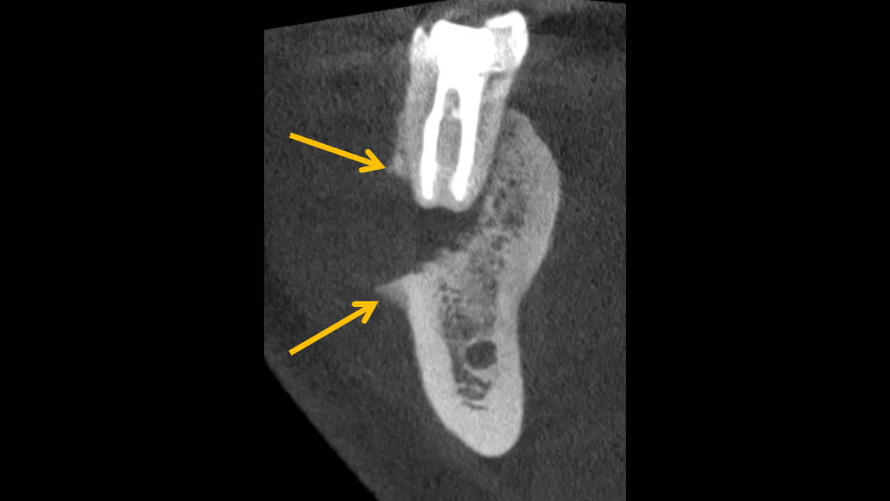 CBCT image of tooth #30 displaying destructive bone lesion with buccal cortex erosion, Codman triangle, and sclerotic trabeculation, suggestive of malignancy