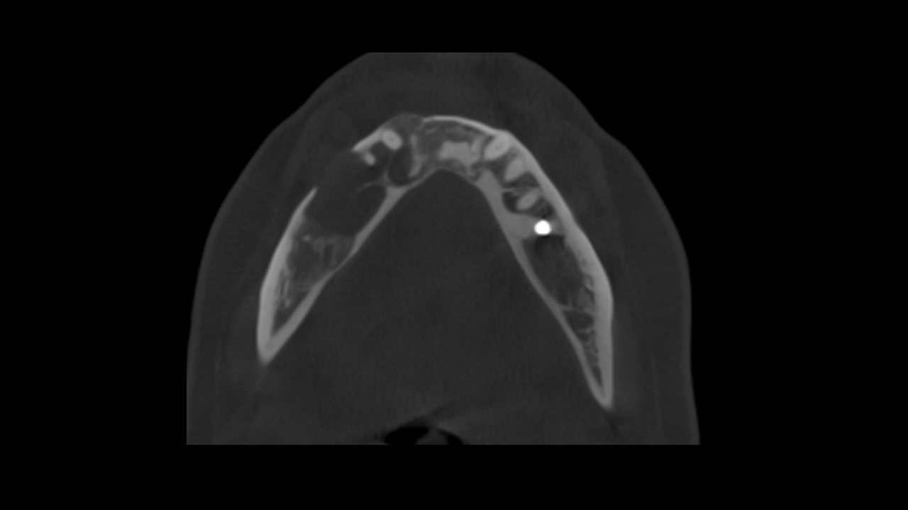 Axial CBCT scan showing vertebral artery region prior to identification of curvilinear radiodensities behind the anterior arch of the atlas