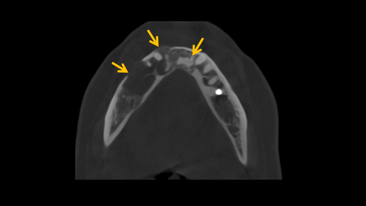 Axial CBCT scan with highlighted curvilinear radiodensities posterior to the anterior arch of the atlas, indicating vertebral artery calcification